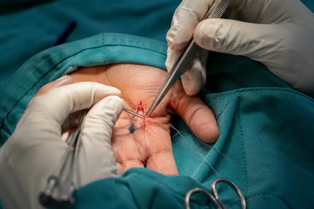 Surgeon suturing a small incision on a patient's finger during hand surgery, using forceps and needle holder.