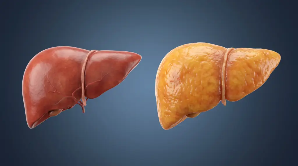 Fatty Liver Disease Fatty Liver Symptoms Fatty Liver Causes Liver Disease Prevention Healthy Liver Tips